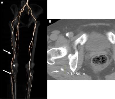 Significance of collateral circulation in managing persistent sciatic artery: Two case reports